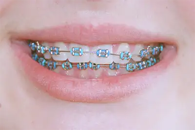 Ortodoncia con brackets