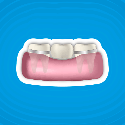 Prótesis dental removible