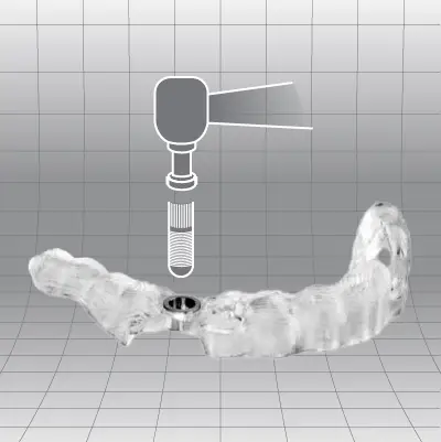 Cirugía guiada para implantes dentales