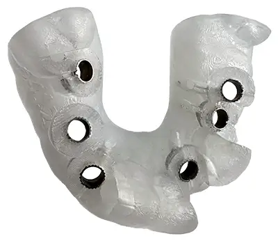Cirugía guiada para implantes dentales