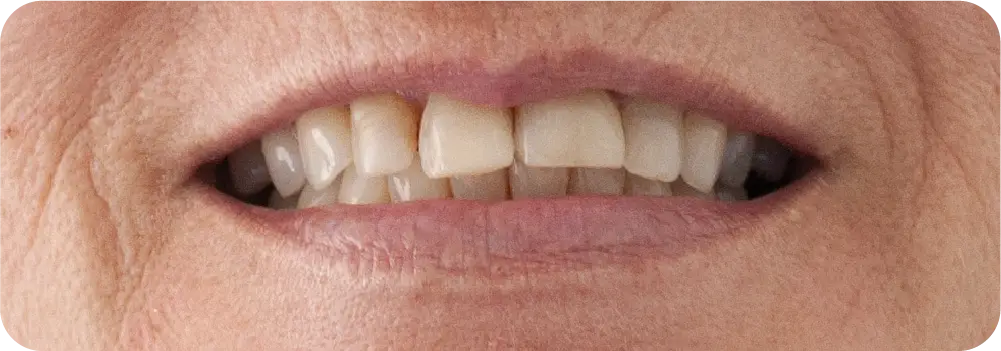 Despues del blanqueamiento dental