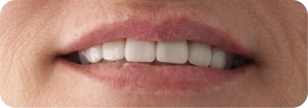Antes de un blanqueamiento dental